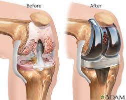 Herbal Knee Pain Relief Patches + FREE Herbal Oil Bottle